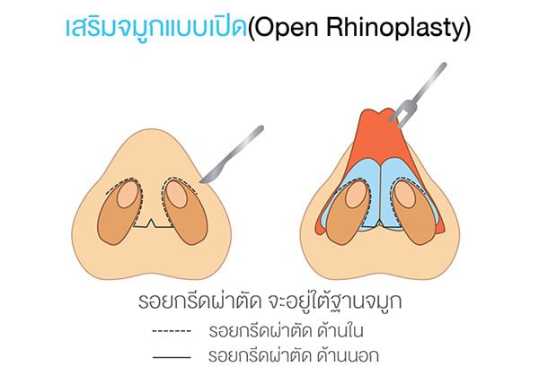 Open Rhinoplasty tonliew clinic