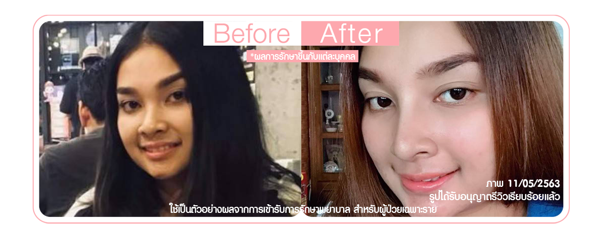 เสริมจมูก เนื้อจมูกบาง ปลายจมูกใหญ่ เสริมจมูก เนื้อจมูกบาง ปลายจมูกใหญ่