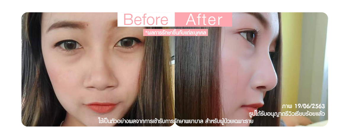 เสริมจมูก ปลายจมูกสั้น เสริมจมูก ปลายจมูกสั้น