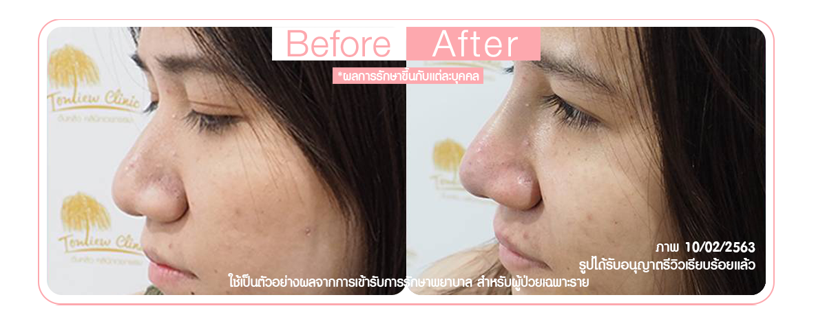 เสริมจมูก คนที่มีฐานกระดูกกว้าง เสริมจมูก คนที่มีฐานกระดูกกว้าง