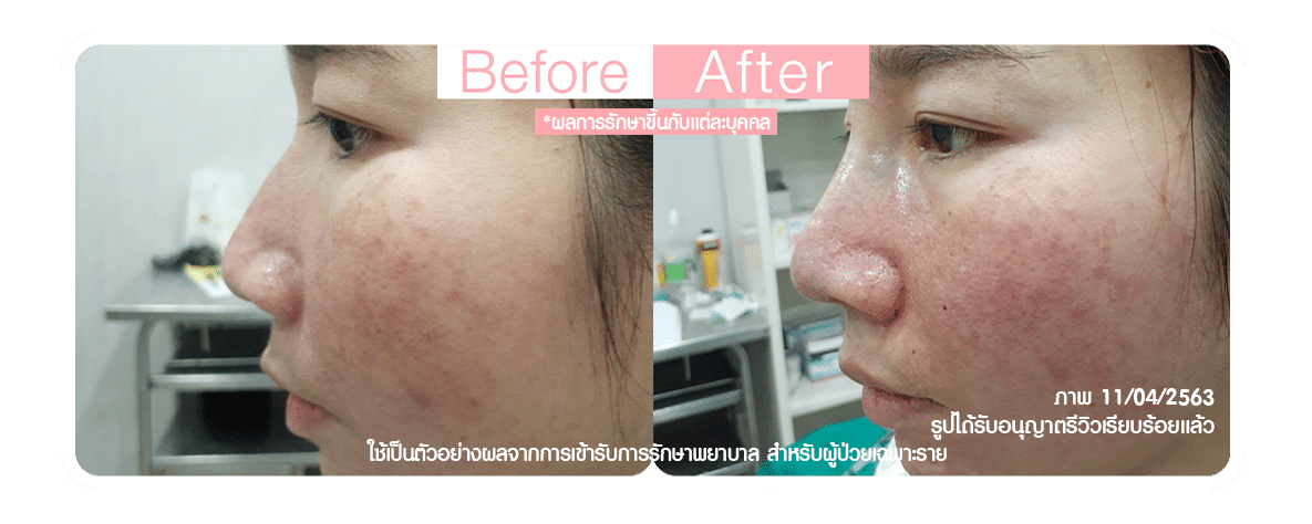 เสริมจมูกกระดูกฮัมพ์สูง เสริมจมูกกระดูกฮัมพ์สูง