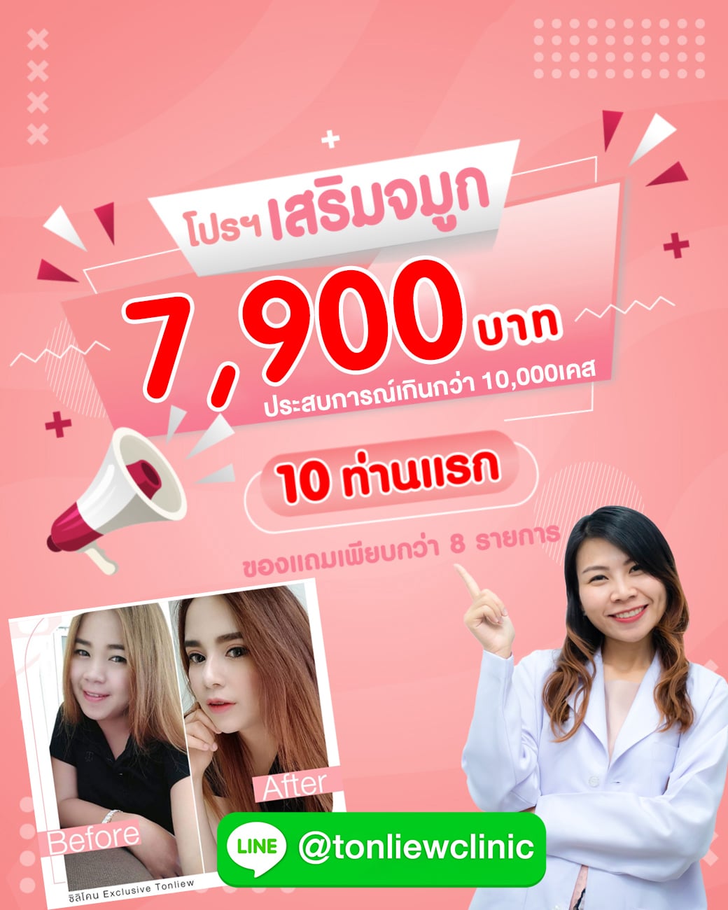 โปรโมชั่น เสริมจมูกราคาถูก 7,900บาท ต้นหลิวคลินิก