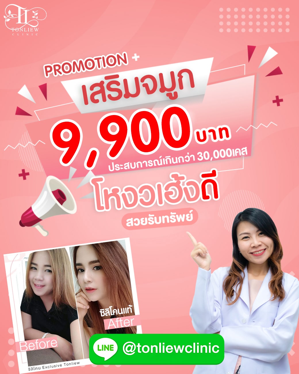 โปรโมชั่น เสริมจมูกราคาถูก 9,900บาท ต้นหลิวคลินิก