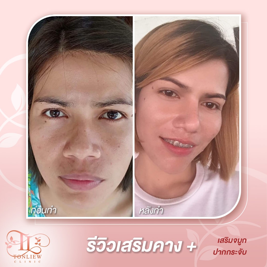รีวิวเสริมคางต้นหลิว คลินิก