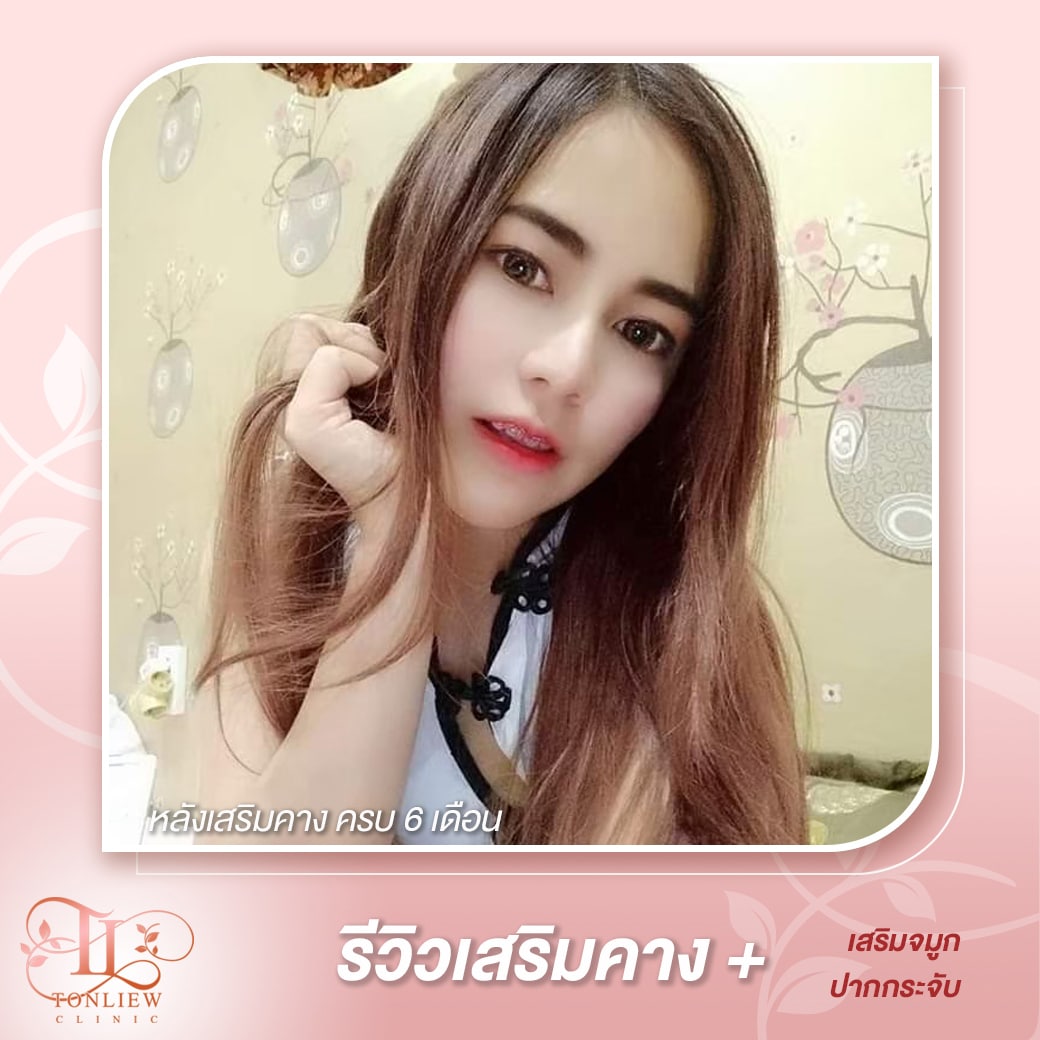 รีวิวเสริมคางต้นหลิว คลินิก