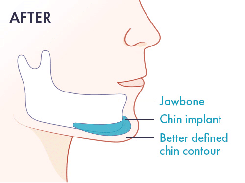 after-chin