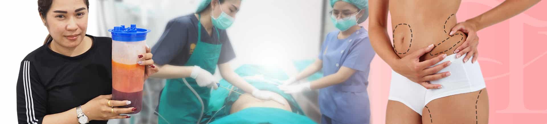 หน้าปกดูดไขมัน vaser-liposuction-tonliewclinic