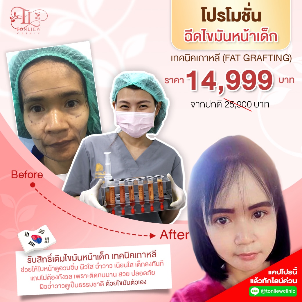 โปรโมชั่น ดูดเติมไขมันหน้าเด็ก
