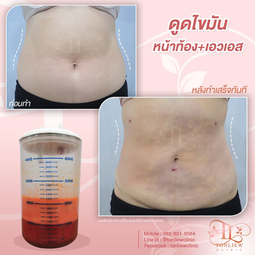 รีวิวดูดไขมันหน้าท้อง เอวเอส ต้นหลิวคลินิก