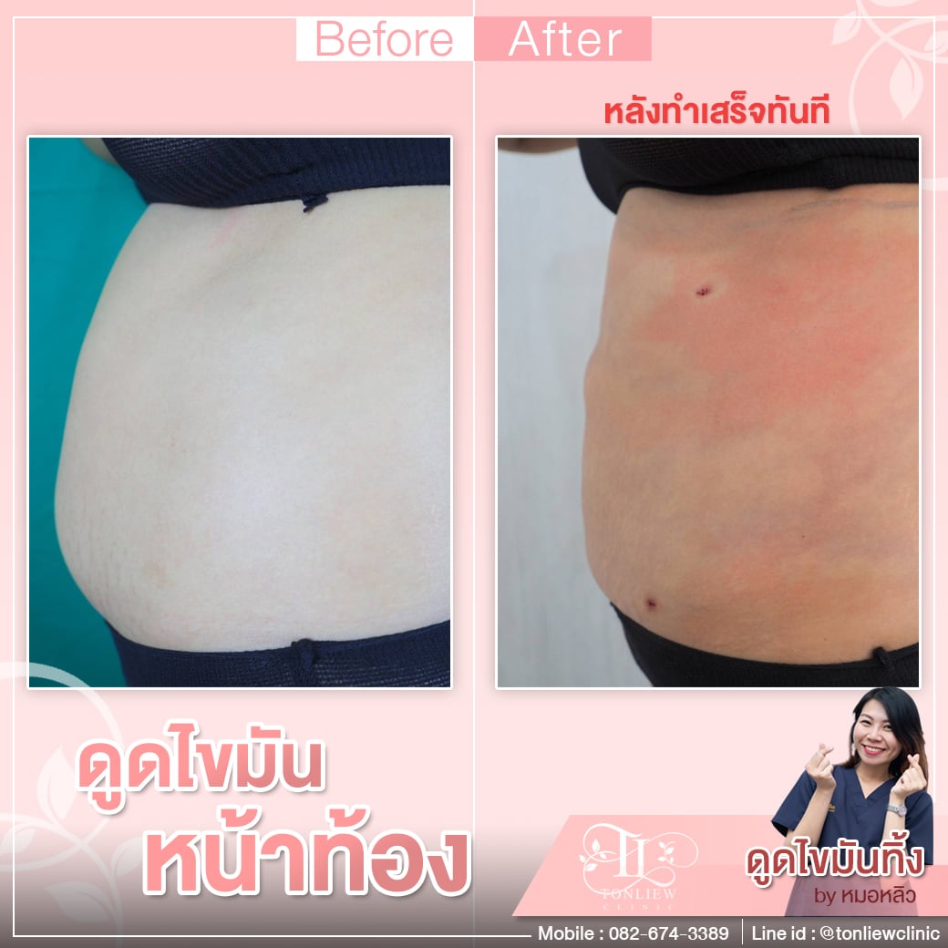 รีวิวดูดไขมันหน้าท้อง ต้นหลิวคลินิก รามอินทรา