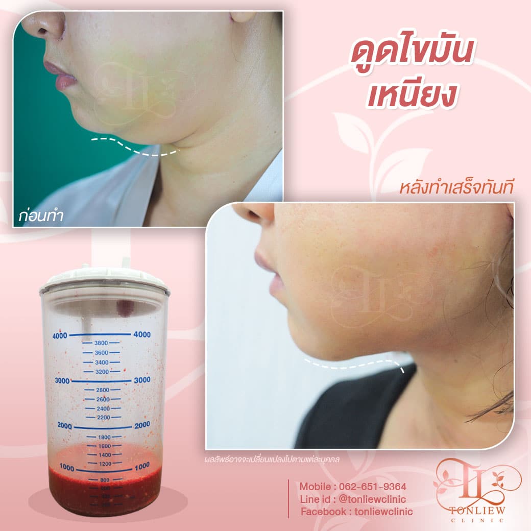 รีวิวดูดไขมันเหนียง ต้นหลิวคลินิก รามอินทรา