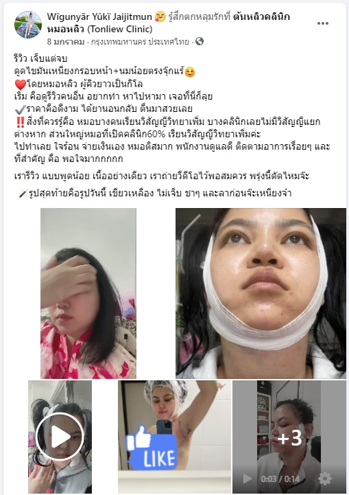 รีวิวดูดไขมันเหนียง ต้นหลิวคลินิก