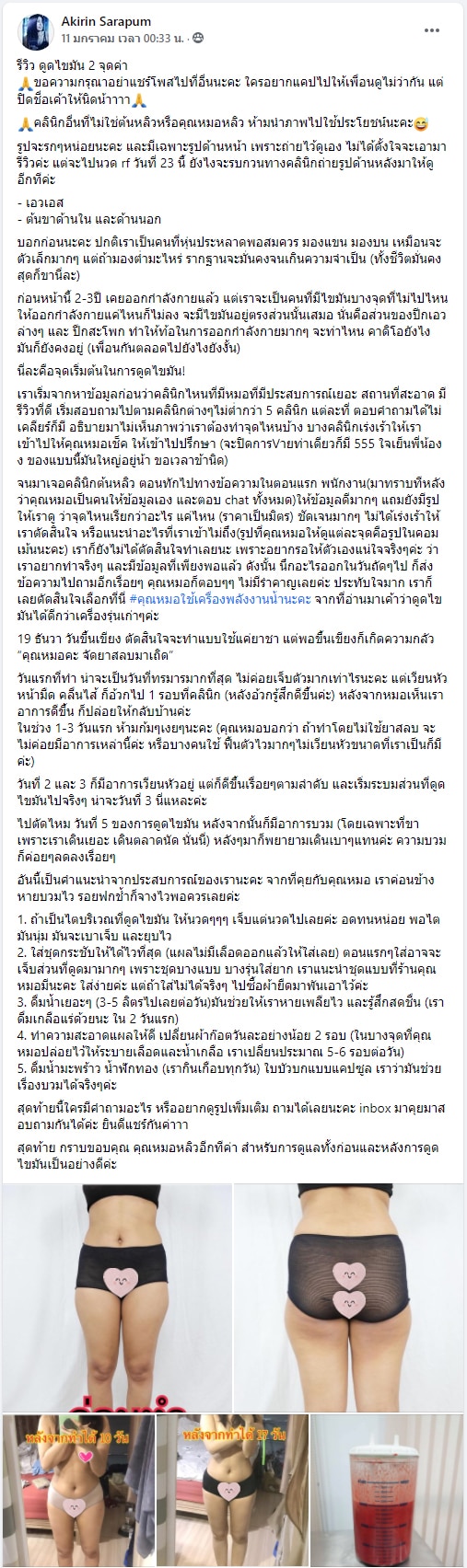 รีวิวดูดไขมัน หมอหลิว ต้นหลิวคลินิก