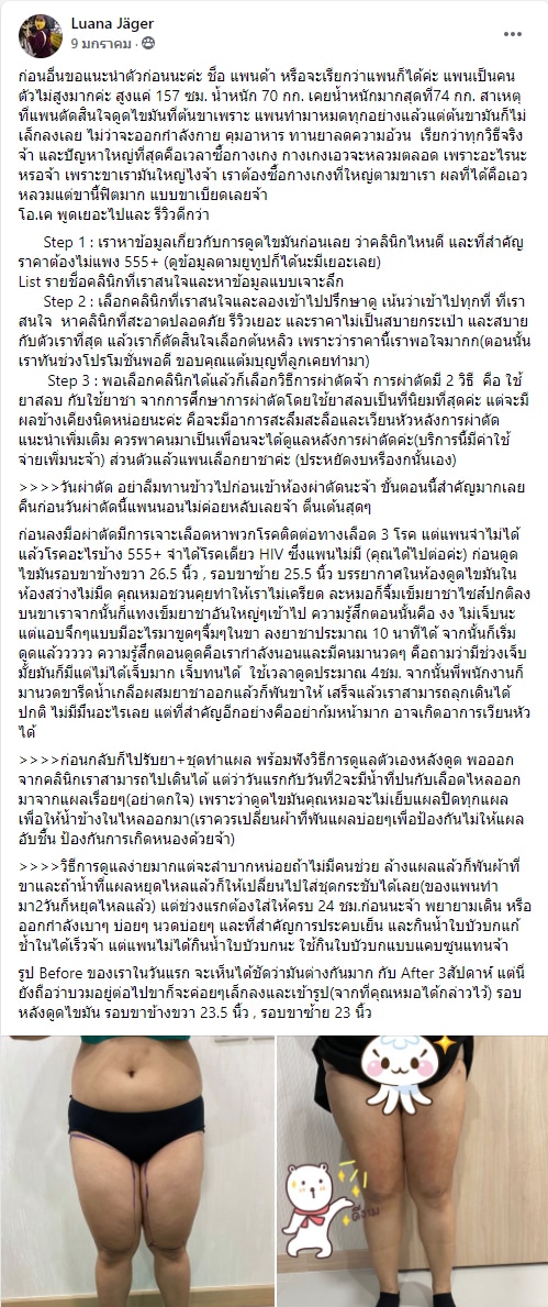 รีวิวดูดไขมัน ต้นหลิวคลินิก
