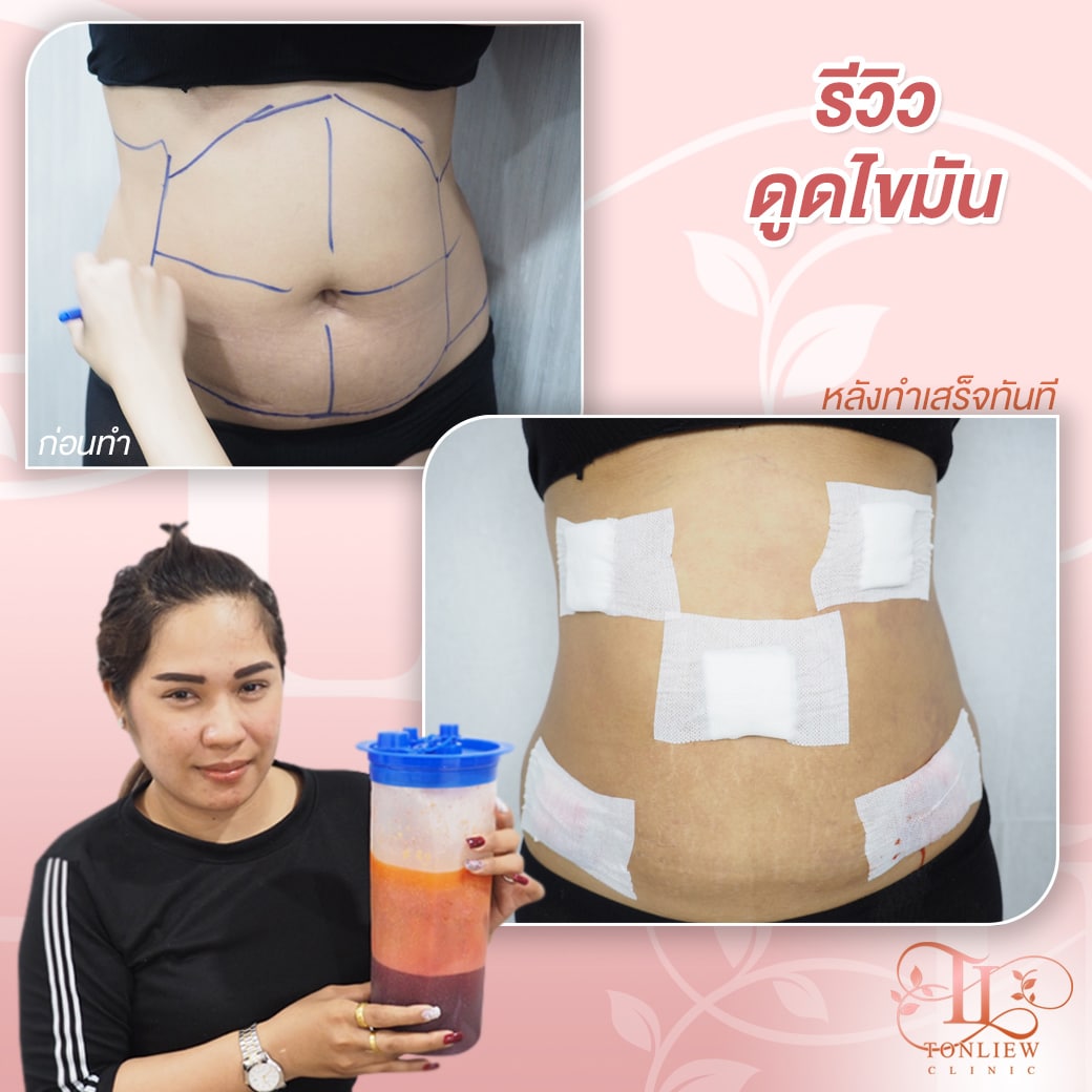 รีวิวดูดไขมันทิ้ง ต้นหลิวคลินิก