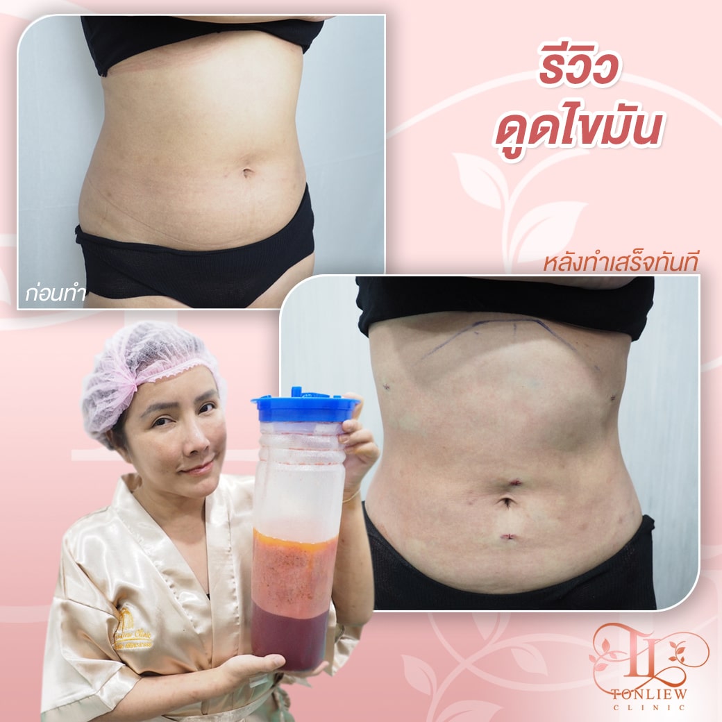รีวิวดูดไขมันหน้าท้อง ต้นหลิวคลินิก