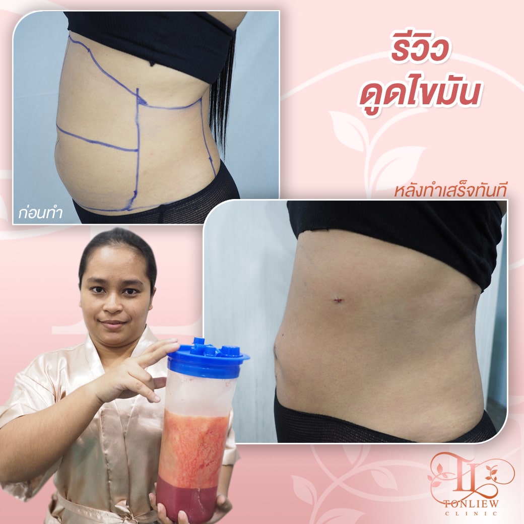 รีวิวดูดไขมันทิ้ง ต้นหลิวคลินิก