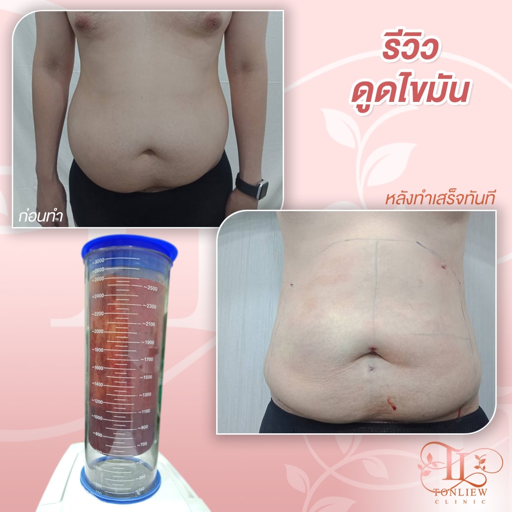 รีวิวดูดไขมันทิ้ง ต้นหลิวคลินิก
