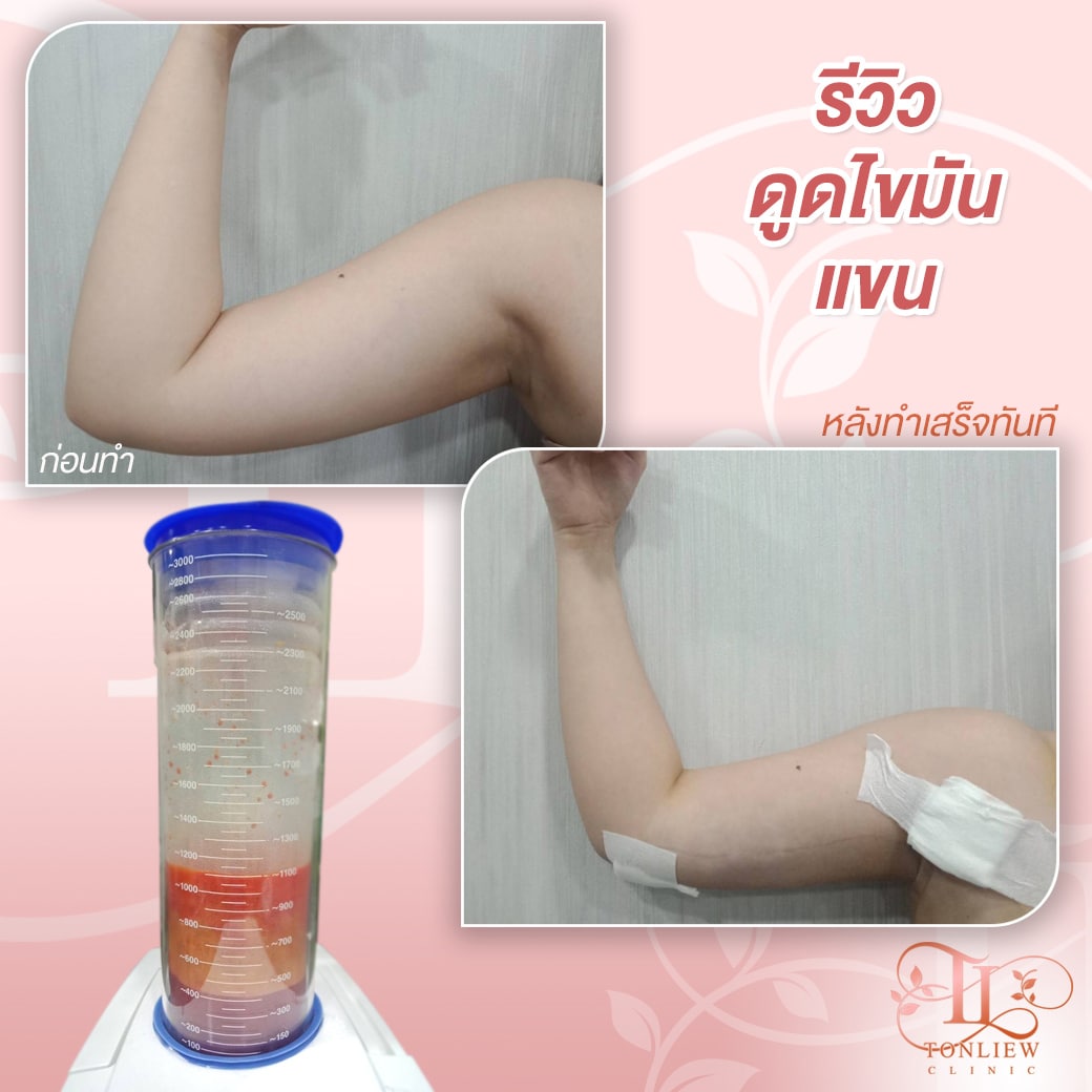 รีวิวดูดไขมันต้นแขน ต้นหลิวคลินิก