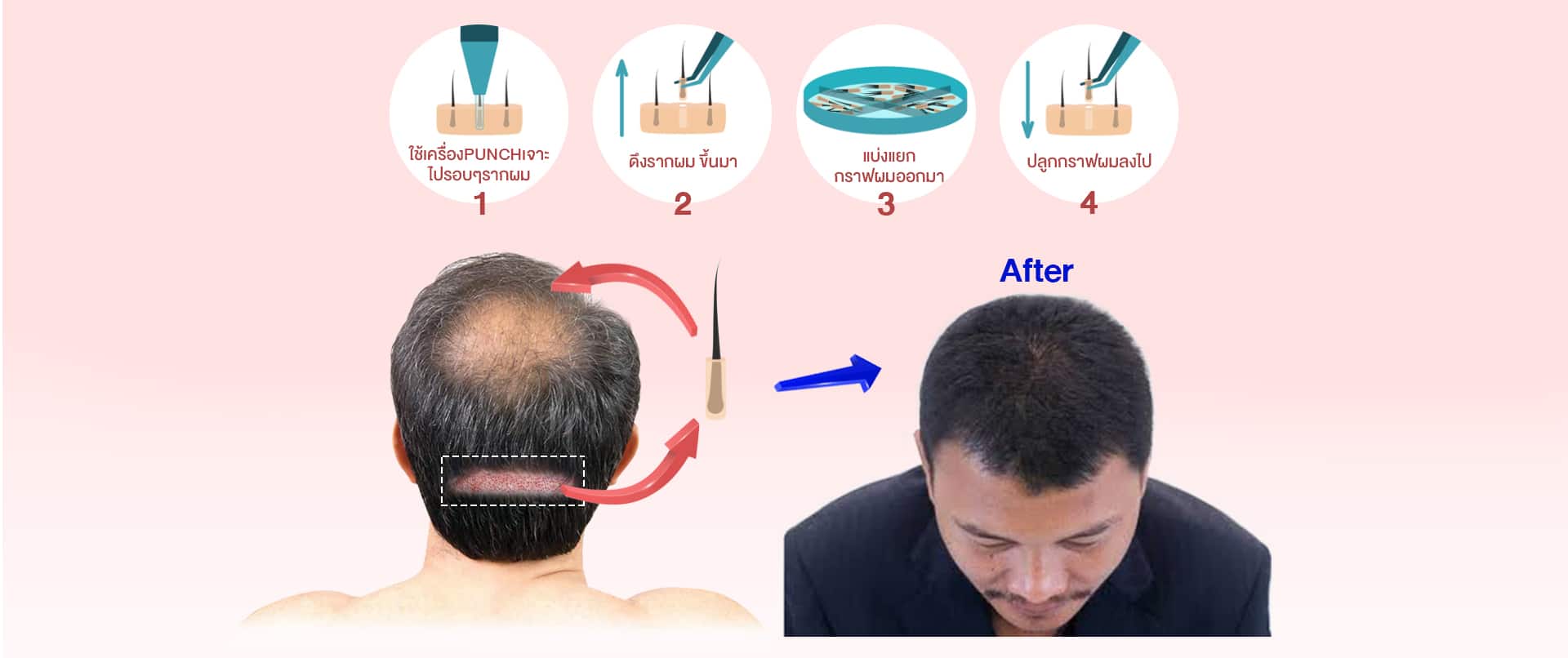 ขั้นตอนการปลูกผม แบบ FUE