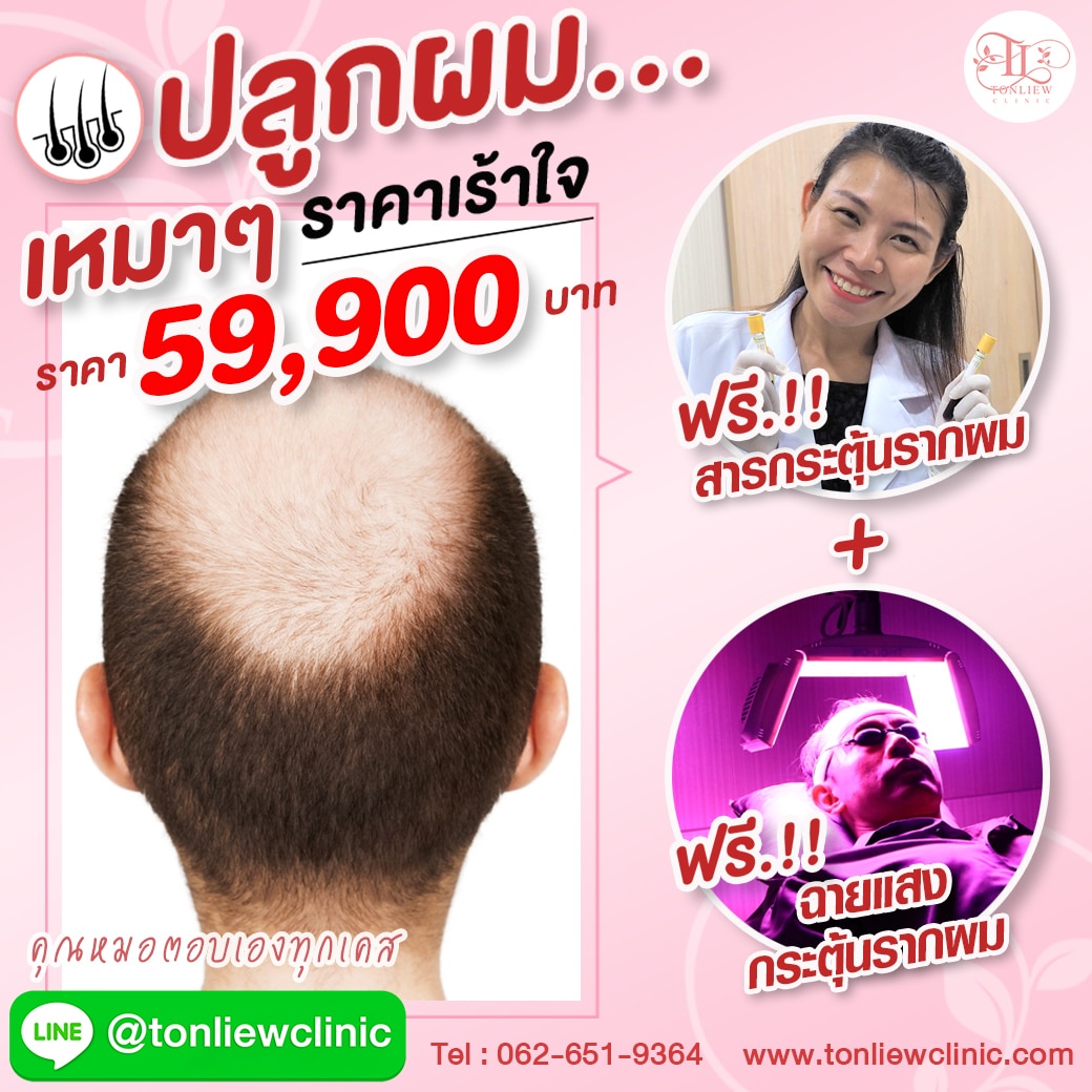 โปรโมชั่นปลูกผมถาวร ราคาถูก 59900บาท