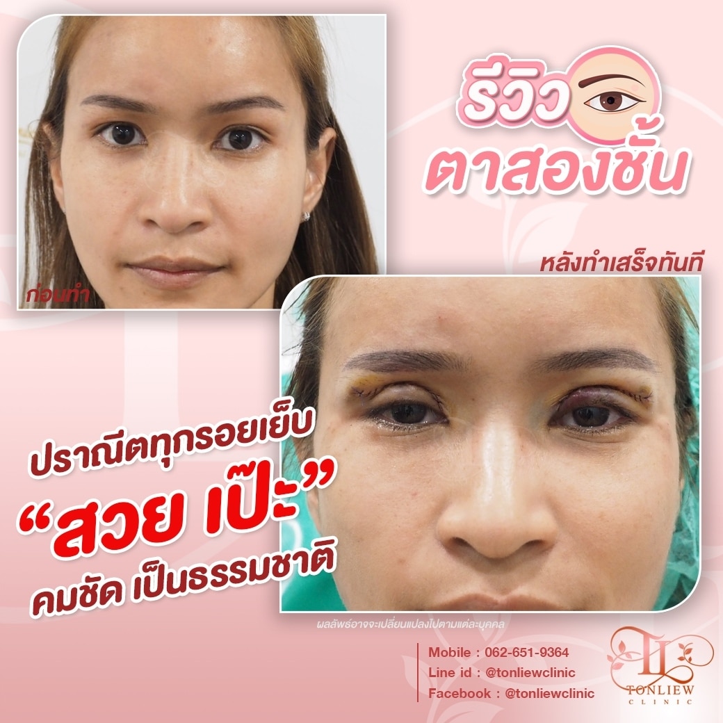 รีวิวทำตาสองชั้น หมอหลิว