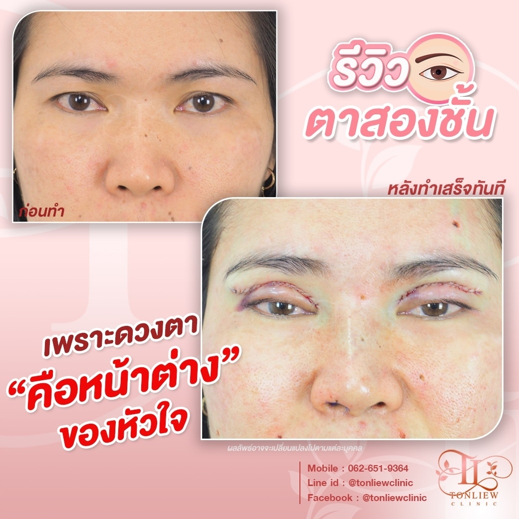 รีวิวทำตาสองชั้น หมอหลิว