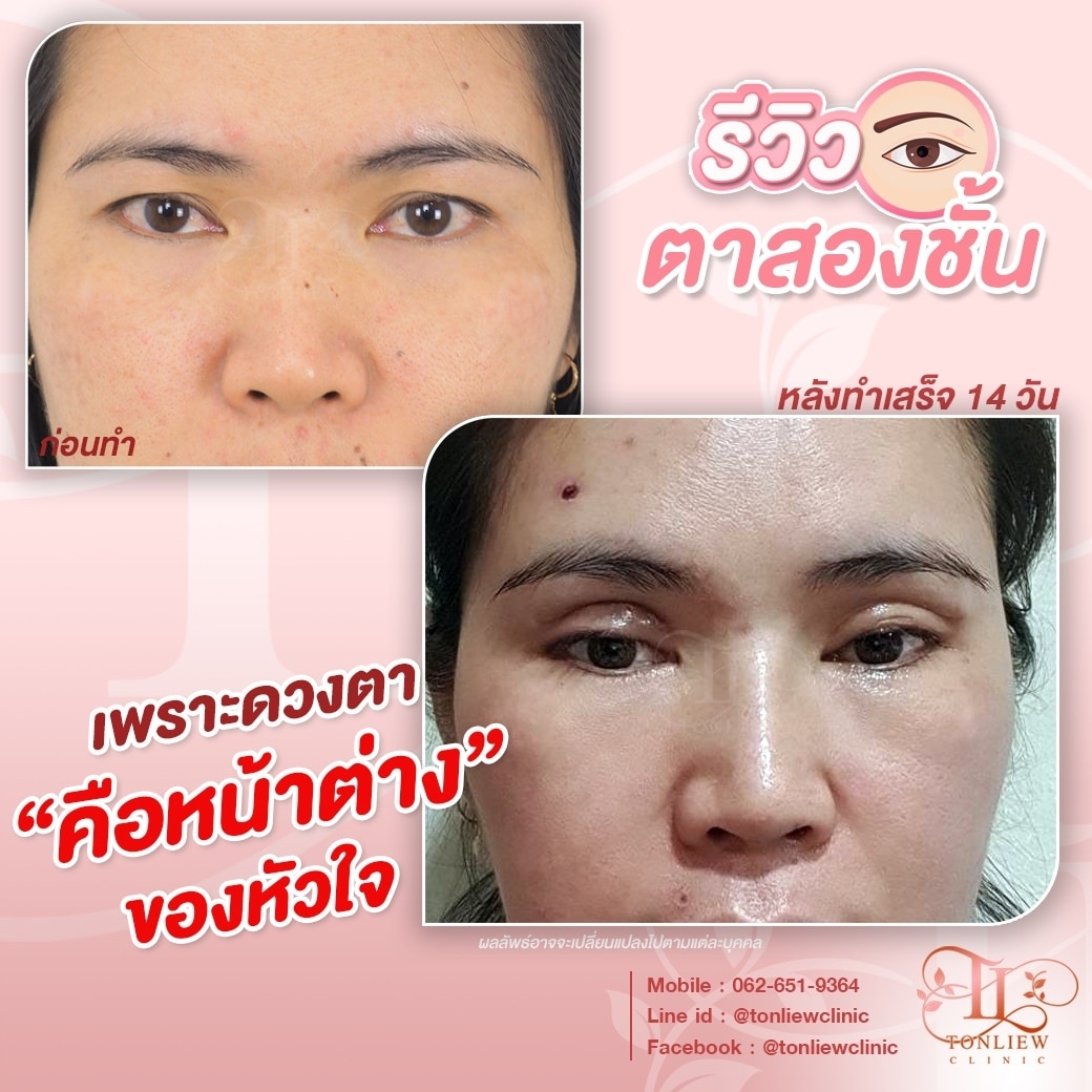 รีวิวทำตาสองชั้น หมอหลิว
