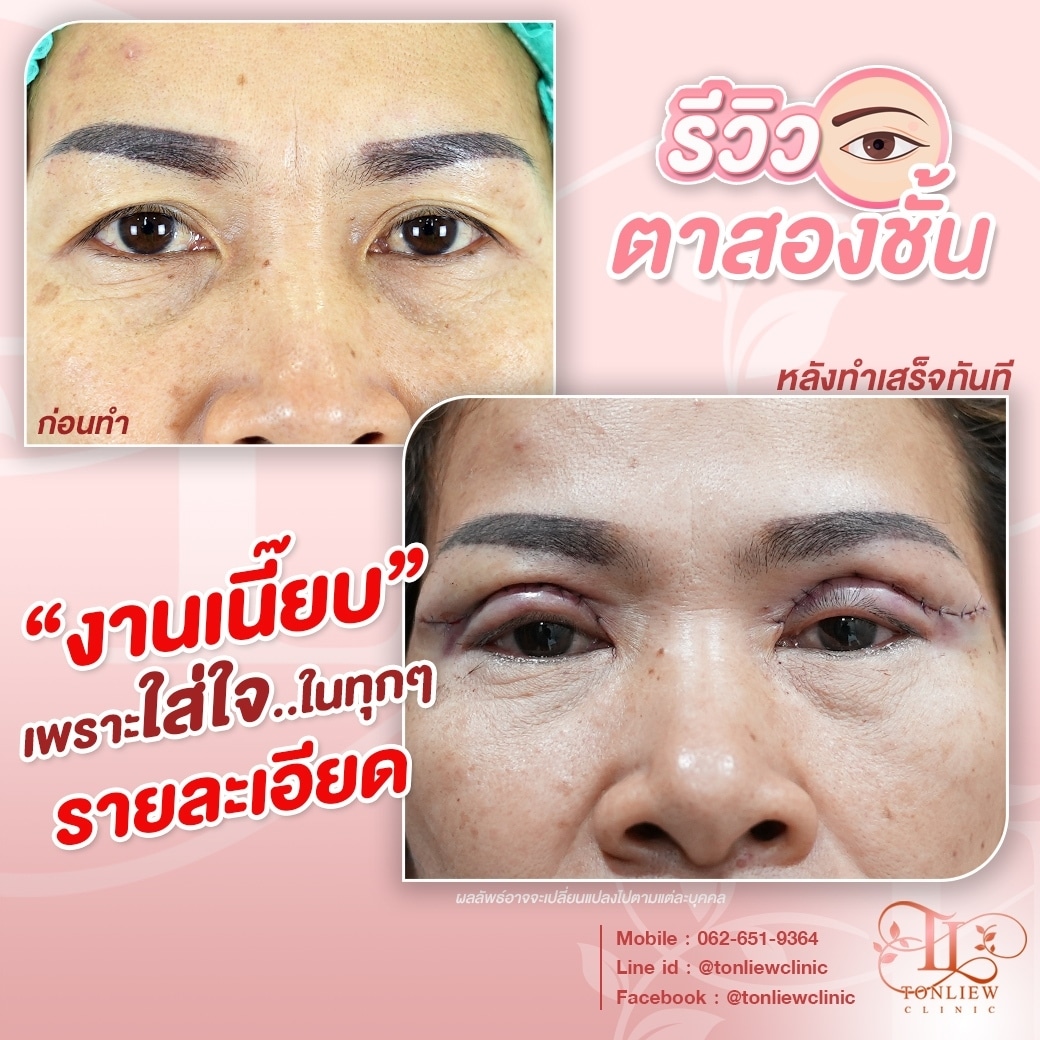 รีวิวทำตาสองชั้น หมอหลิว