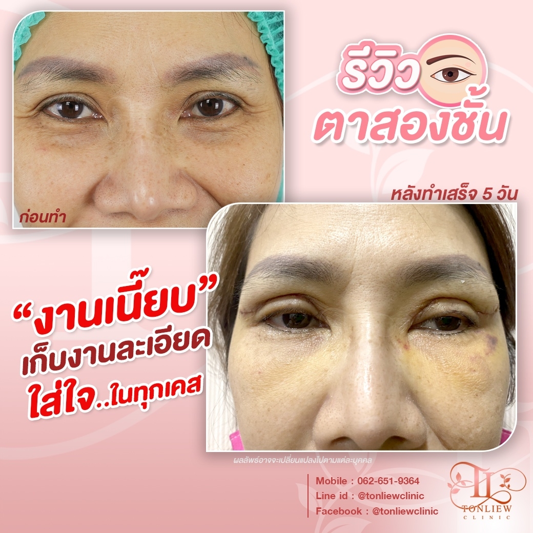 รีวิวทำตาสองชั้น หมอหลิว