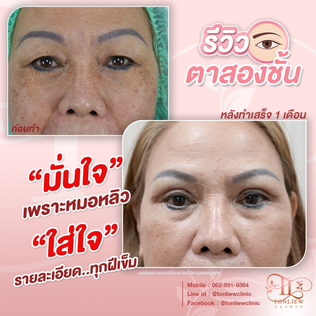 รีวิวทำตาสองชั้น หมอหลิว