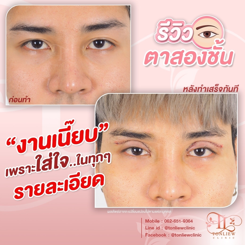 รีวิวทำตาสองชั้น หมอหลิว