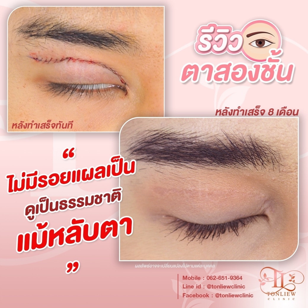 รีวิวทำตาสองชั้น หมอหลิว