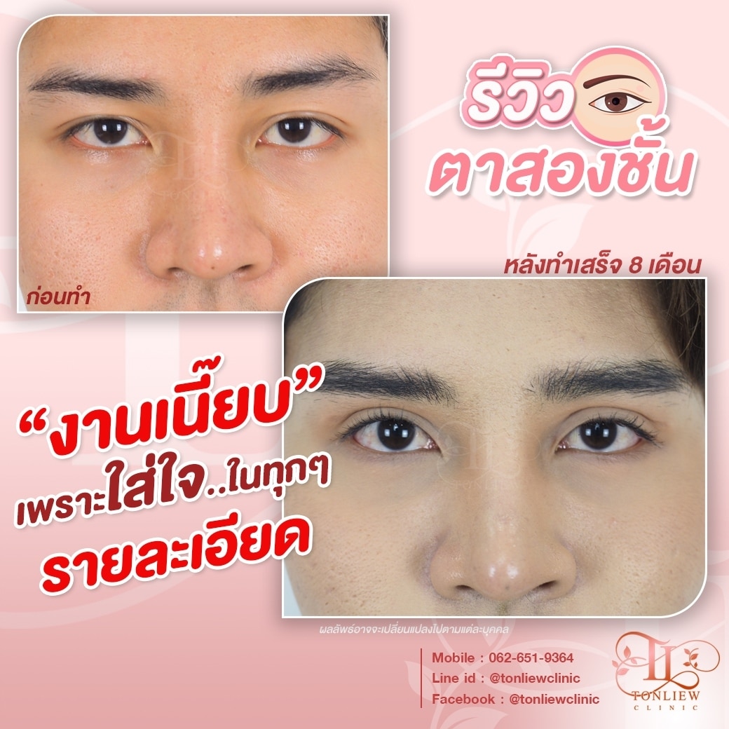 รีวิวทำตาสองชั้น หมอหลิว