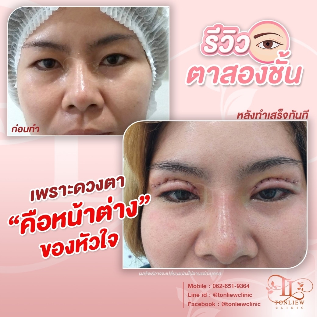 รีวิวทำตาสองชั้น หมอหลิว