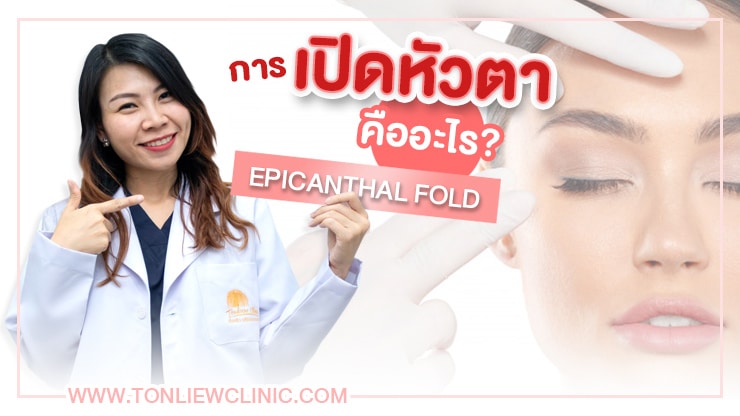 การเปิดหัวตา คืออะไร? (Epicanthal fold)