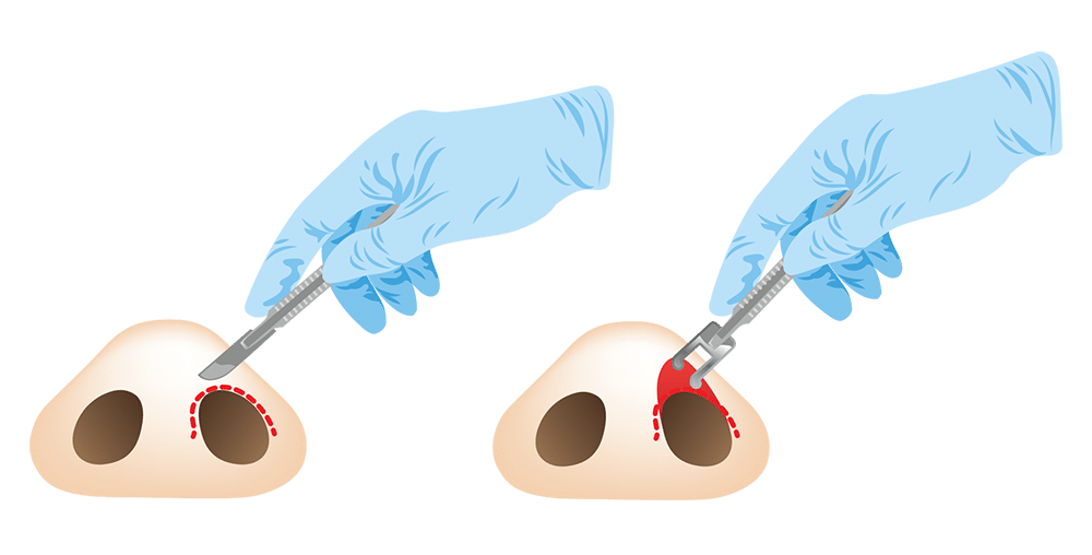 การเสริมจมูกแบบปิด (Close Rhinoplasty)