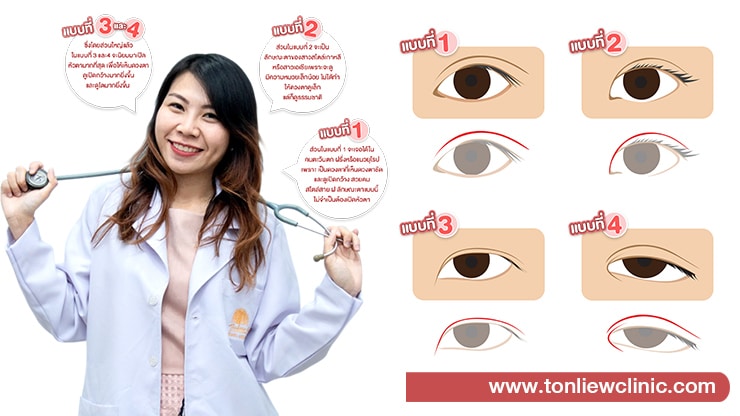 การเปิดหัวตา คืออะไร? และมีกี่แบบ? (EPICANTHAL FOLD)
