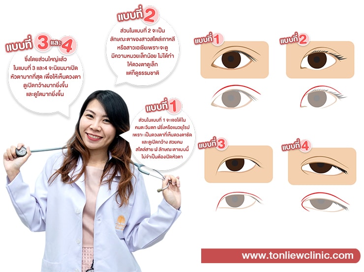 การเปิดหัวตา คืออะไร? และมีกี่แบบ? (EPICANTHAL FOLD)