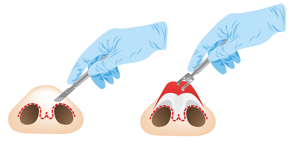 การเสริมจมูกแบบเปิด (Open Rhinoplasty)