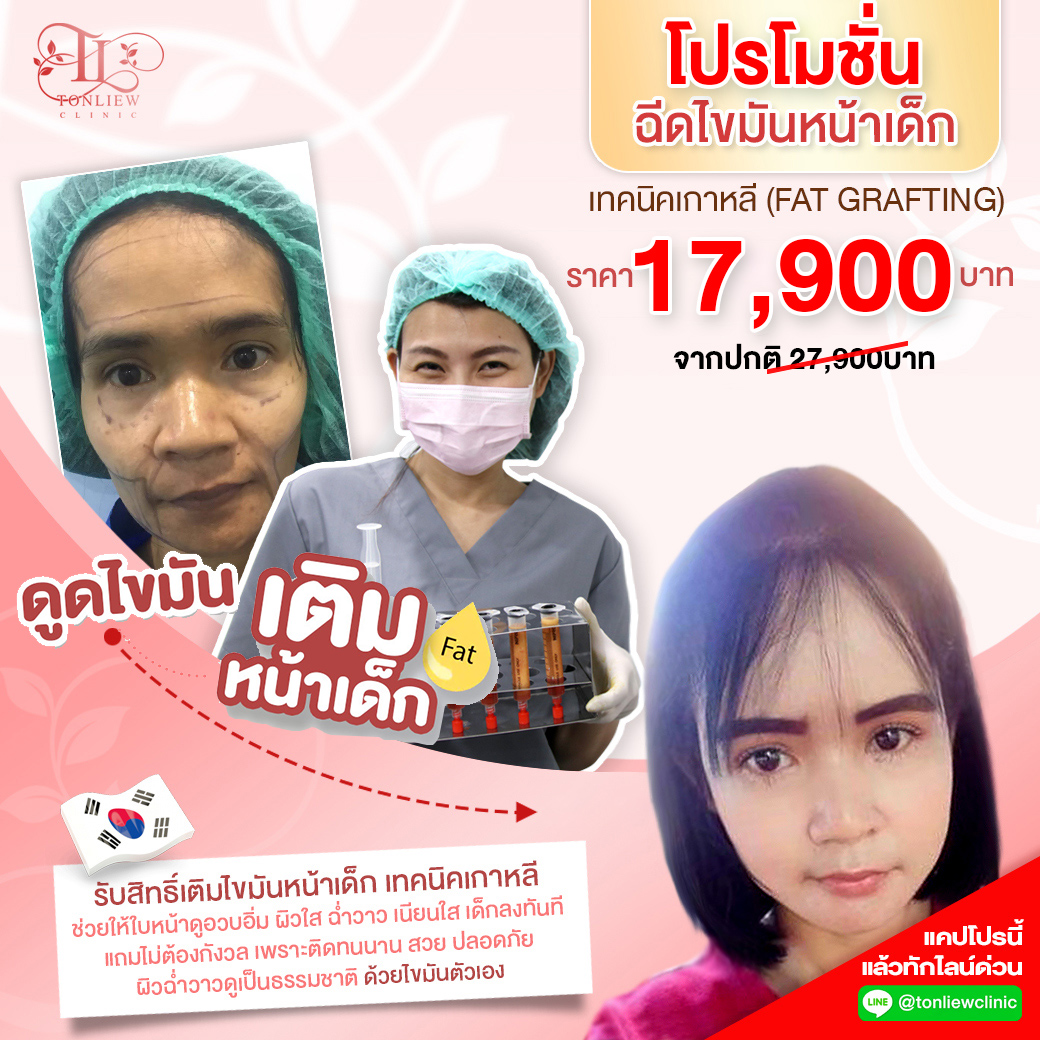 โปรโมชั่น ดูดเติมไขมันหน้าเด็ก โปรโมชั่น ดูดเติมไขมันหน้าเด็ก