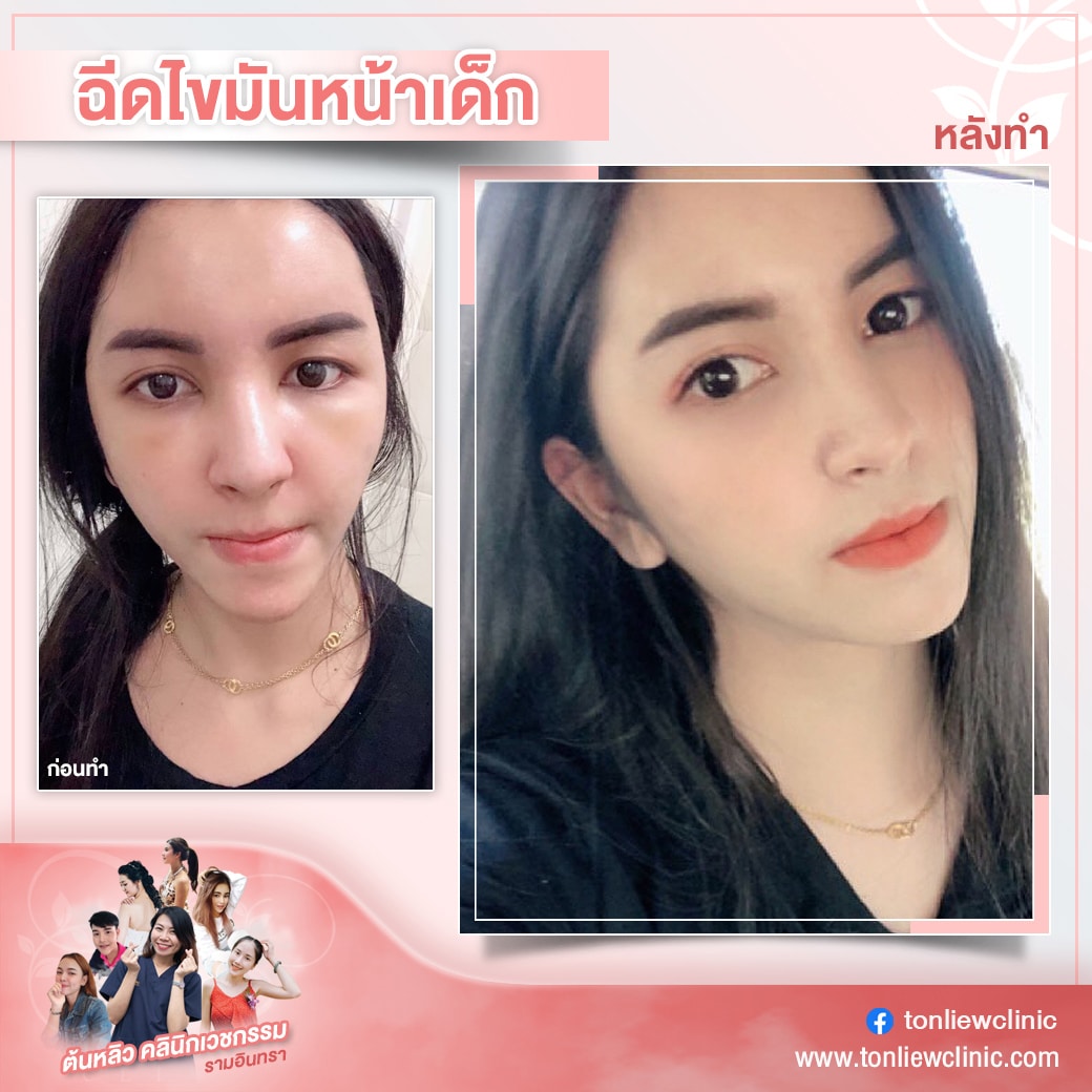 รีวิวฉีดไขมันหน้าเด็ก