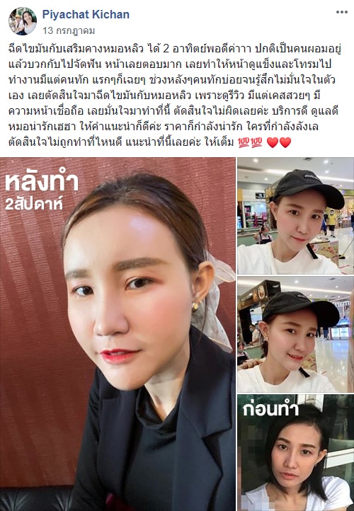 รีวิวฉีดไขมันหน้าเด็ก ต้นหลิว คลินิก