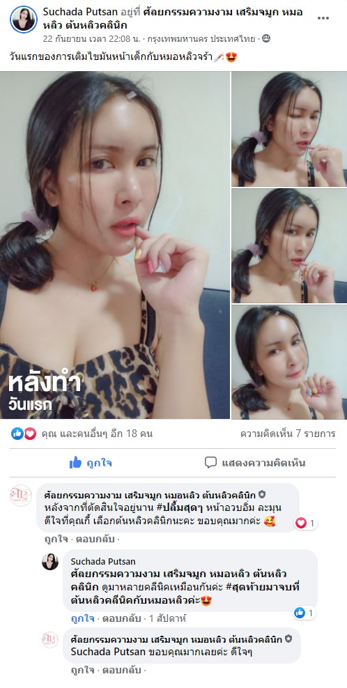 รีวิวฉีดไขมันหน้าเด็ก หมอหลิว ต้นหลิวคลินิก