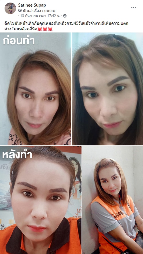 รีวิวฉีดไขมันหน้าเด็ก หมอหลิว ต้นหลิวคลินิก