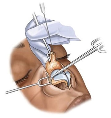 การแก้จมูก วิธีแบบเปิด Open Rhinoplasty