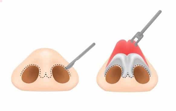 ผ่าแก้จมูก วิธีแบบเปิด Open Rhinoplasty