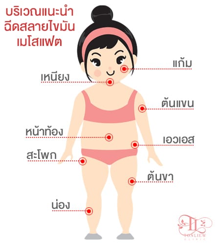 บริเวณที่ทำ เมโสแฟต (meso fat)