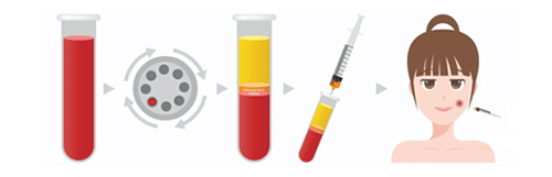 ขั้นตอนการทำ PRP (Platelet rich plasma)