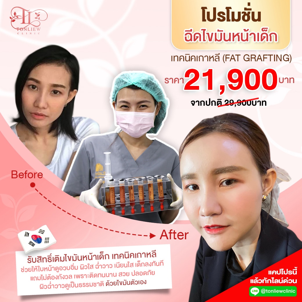 โปรโมชั่นฉีดไขมัน เติมหน้าเด็ก ราคาถูก